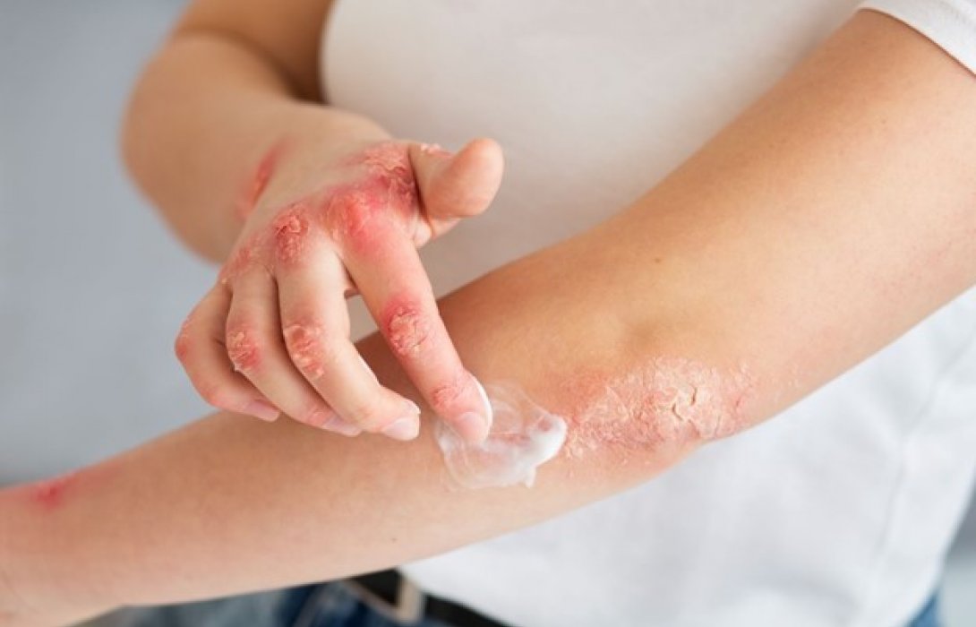Eczema คืออะไร เกิดจากอะไร มีอะไรบ้างเป็นตัวกระตุ้น ?