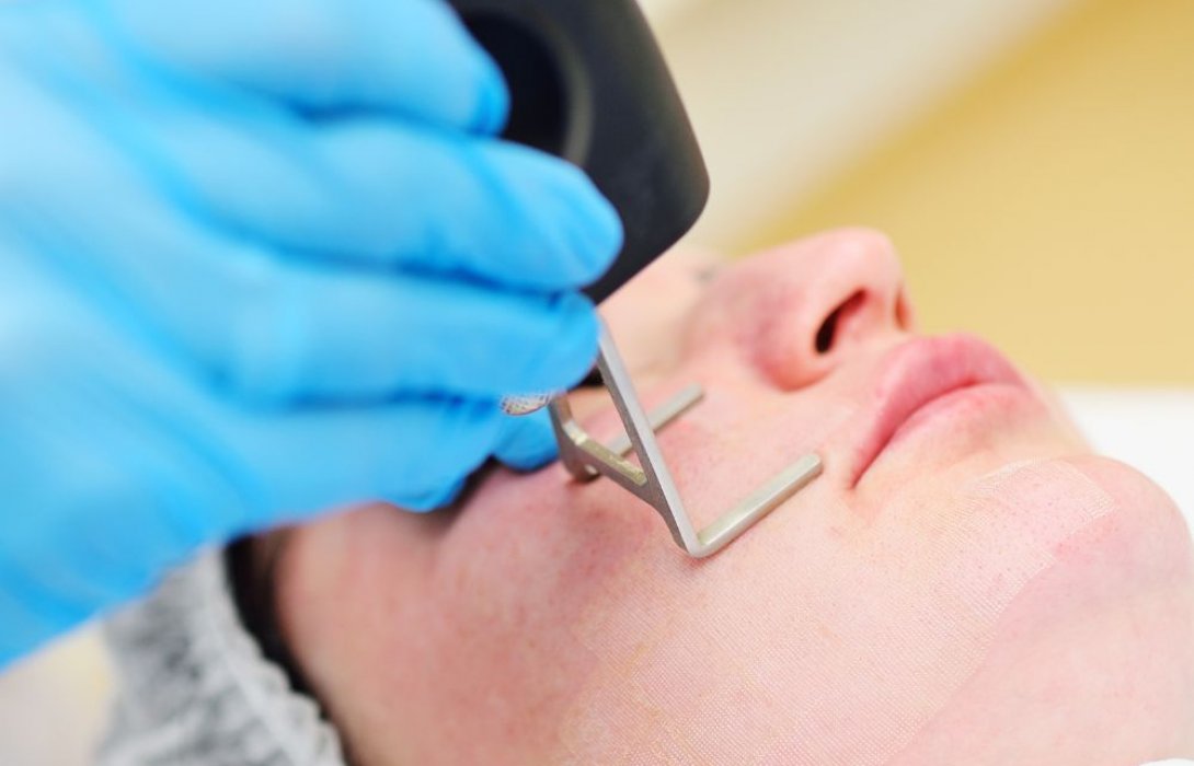 แก้หลุมสิวเรื้อรัง เริ่มต้นด้วยเลเซอร์หลุมสิวแบบไหนดี? 