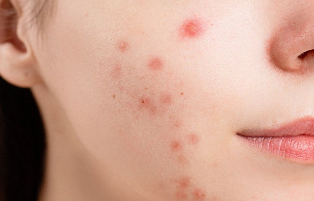 สิวอุดตัน ที่คางขึ้นซ้ำไม่หาย ควรกดไหม รักษายังไงไม่ให้ทิ้งรอยดำ