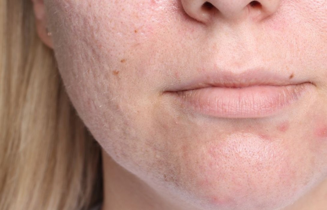 รวมวิธีรักษาหลุมสิวให้ตื้นขึ้น ปลอดภัย ฉบับคลินิกผิวหนังแนะนำ