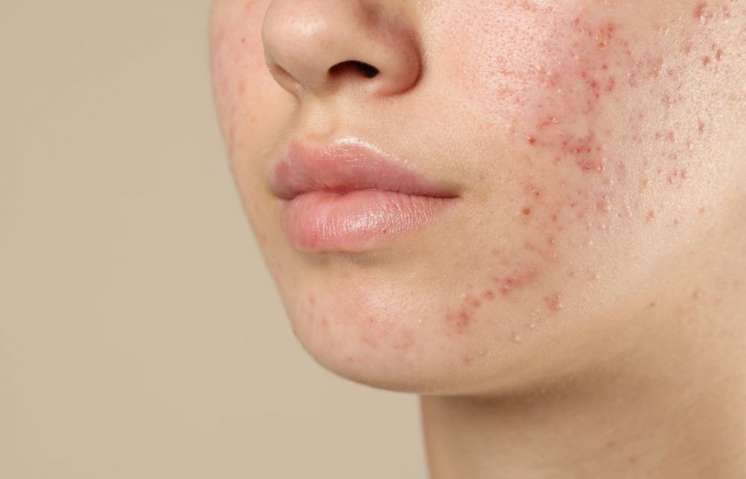 สิวผด รักษาอย่างเร่งด่วน ควรทำอะไรทันที ให้สิวยุบไว ไม่ลุกลาม