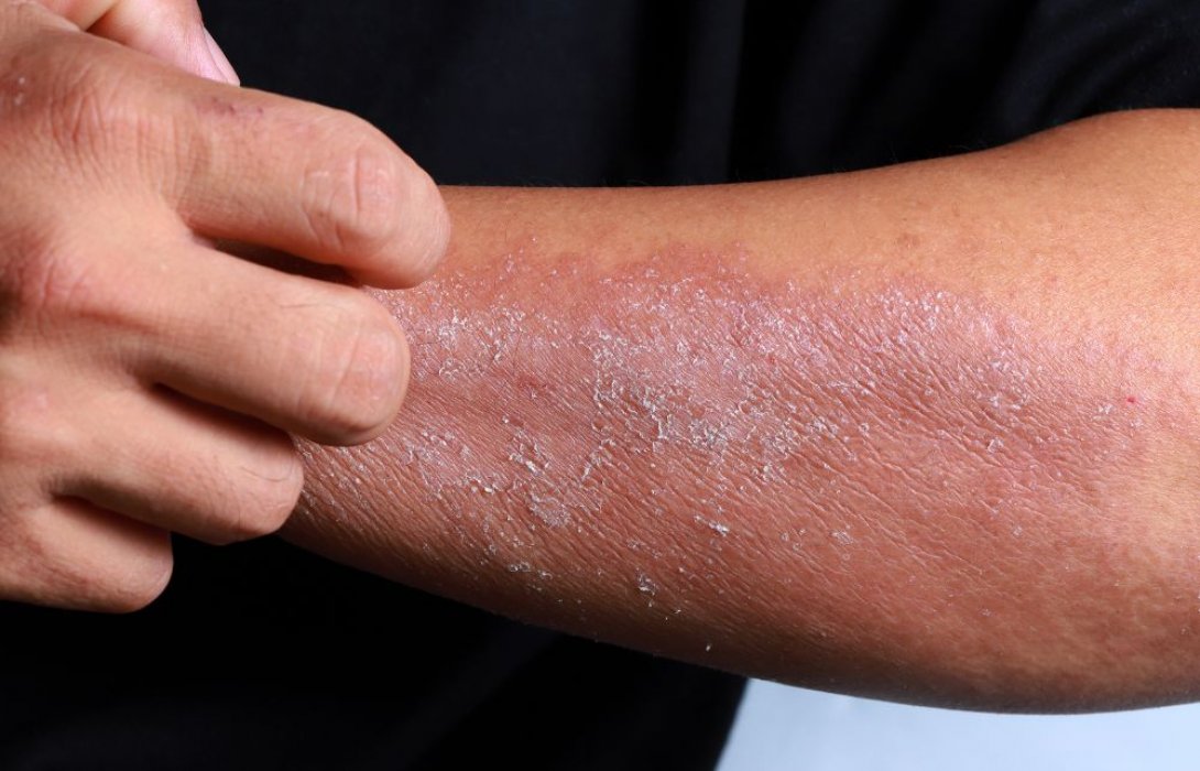 โรคผิวหนังป้องกันได้ เคล็ดลับลดความเสี่ยงโรคผิวหนังที่คนรักผิวไม่ควรมองข้าม